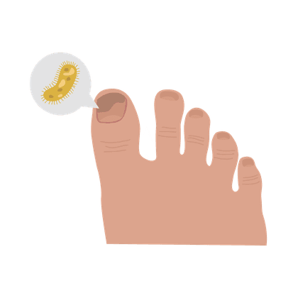 Nail fungus (onychomycosis) and foot fungus (athlete's foot)