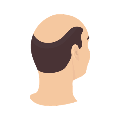 Alopecia (baldness, hair loss)  