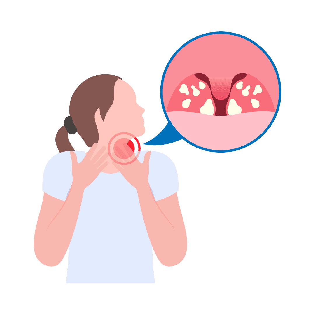 Angina and tonsillitis