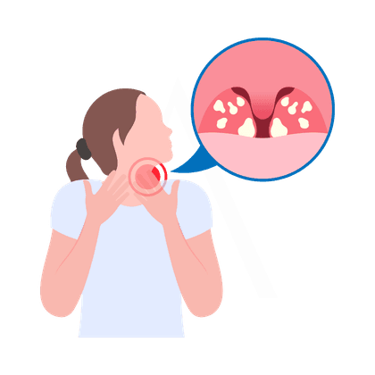 Angina and tonsillitis