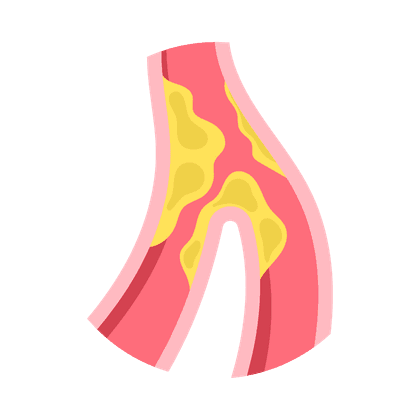 Atherosclerosis