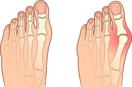 Hallux valgus (bunion)